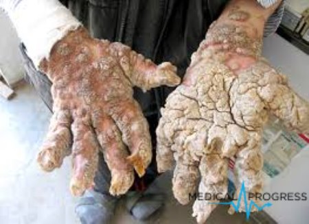 Epidermodysplasia verruciformis lub dysplazja Lewandowsky'ego-Lutza
