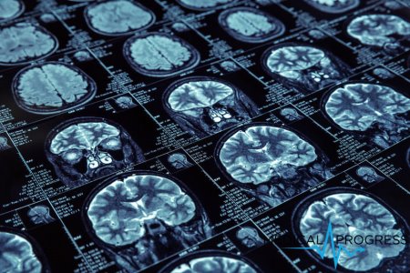 Nowo rozpoznane zaburzenie funkcji mózgu może naśladować chorobę Alzheimera. Czym się różni?