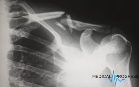 Terapia antyandrogenowa może napędzać rozprzestrzenianie się guzów kości w zaawansowanym raku prostaty